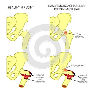 Hip joint problem_Cam femoroacetabular impingement photo