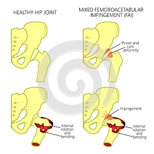 Hip joint problem_Mixed femoroacetabular impingement