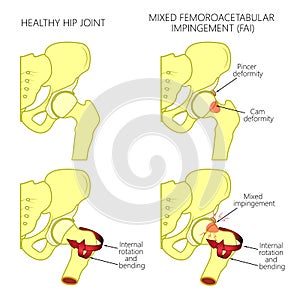 Hip joint problem_Mixed femoroacetabular impingement with section photo