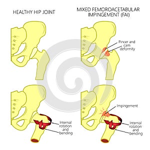 Hip joint problem_Mixed femoroacetabular impingement photo