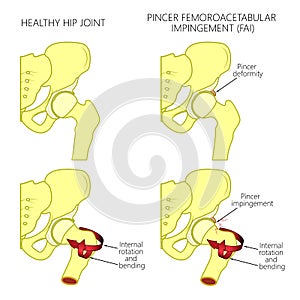 Hip joint problem_Pincer femoroacetabular impingement with section photo