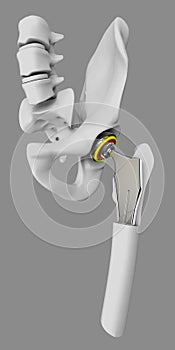 Hip joint replacement, artificial joint gray 3d Illustration
