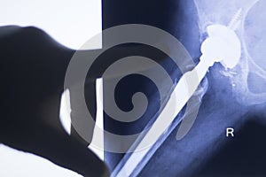 Hip joint replacement impant