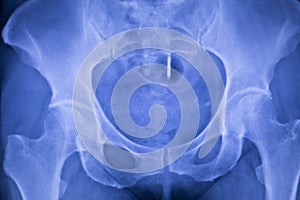 Hip joint replacement xray