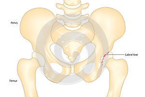 Hip labral tear