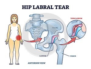 Hip labral tear explanation as medical labrum bone damage outline diagram photo