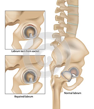 Hip Labral Tears. Labrum torn from socket and Repaired labrum. Surgery for Repairing a Torn Hip Labral photo