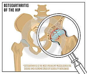 Hip Osteoarthritis Image