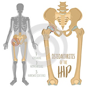 Hip Osteoarthritis Image
