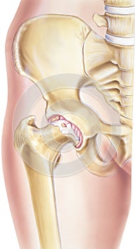 Hip - Osteoarthritis of the joint