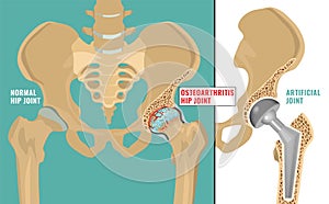 Hip Osteoarthritis Poster