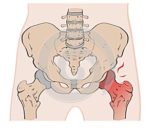 Hip pain. In the hip joint, the head of the femur (thighbone) swivels within the acetabulum. photo
