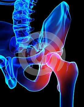 Hip painful skeleton x-ray, 3D illustration.