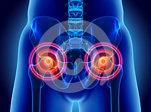 Hip painful skeleton x-ray, 3D illustration.