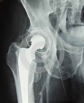 Hip prosthesis implant, hip replacement photo