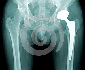 Hip x-ray with replacement of the joint