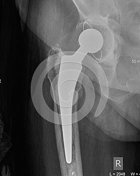 Hip x-ray with replacement of the joint,4 years after surgery