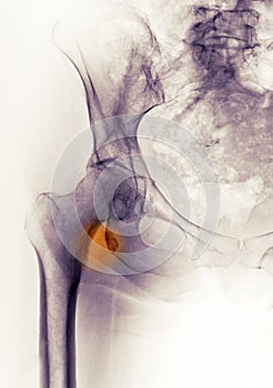 Hip x-ray showing a fracture