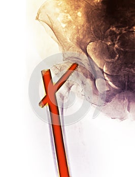 Hip x-ray showing a fracture