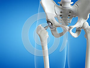 A hip replacement