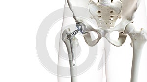 A hip replacement