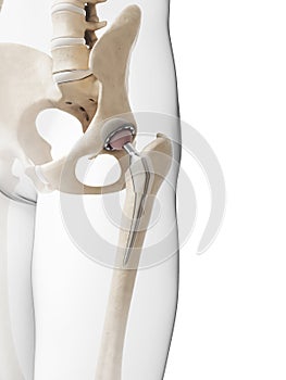 Hip replacement