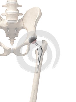 Hip replacement