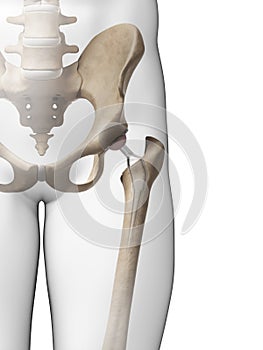 Hip replacement photo