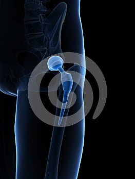 Hip replacement