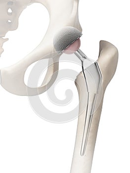 Hip replacement photo