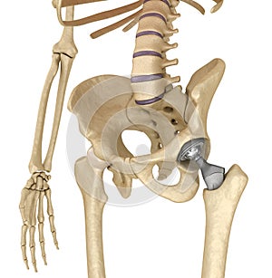 Hip replacement implant installed in the pelvis bone.