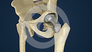 Hip replacement implant installed in the pelvis bone.