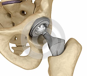 Hip replacement implant installed in the pelvis bone photo
