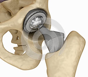 Hip replacement implant installed in the pelvis bone. photo