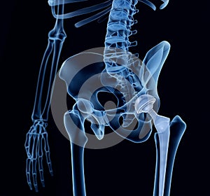 Hip replacement implant installed in the pelvis bone. X-ray view.