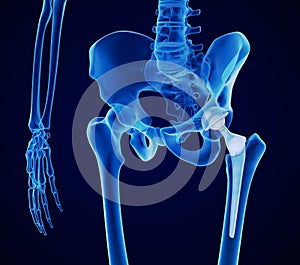 Hip replacement implant installed in the pelvis bone. X-ray view. Medically accurate illustration