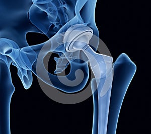 Hip replacement implant installed in the pelvis bone. X-ray view. photo