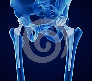 Hip replacement implant installed in the pelvis bone. X-ray view. Medically accurate illustration photo