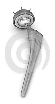 Hip replacement implant. Medically accurate 3D illustration