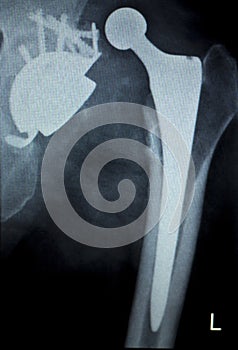 Hip replacement implant Xray scan