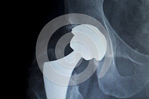 Hip replacement implant Xray scan