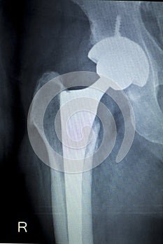 Hip replacement implant Xray scan