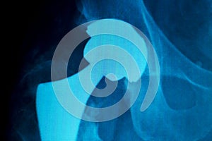 Hip replacement implant Xray scan
