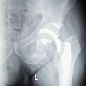 Hip replacement orthopedics implant xray