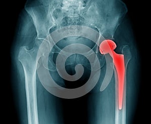 Hip replacement x-ray