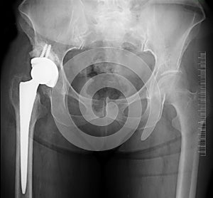 Hip replacement x-ray