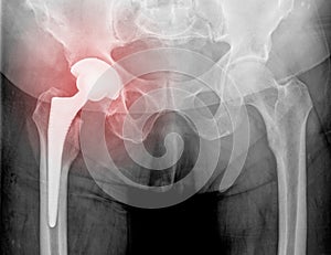 Hip replacement x-ray, 8 weeks after surgery