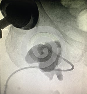 Hip replacement surgery drainage pelvic area