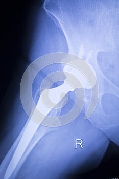 Hip replacement xray orthopedic medical scan