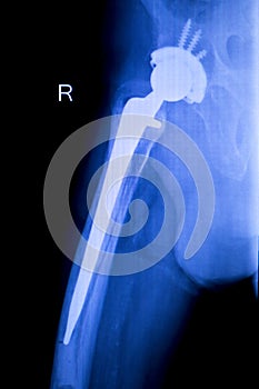 Hip replacement xray orthopedic medical scan